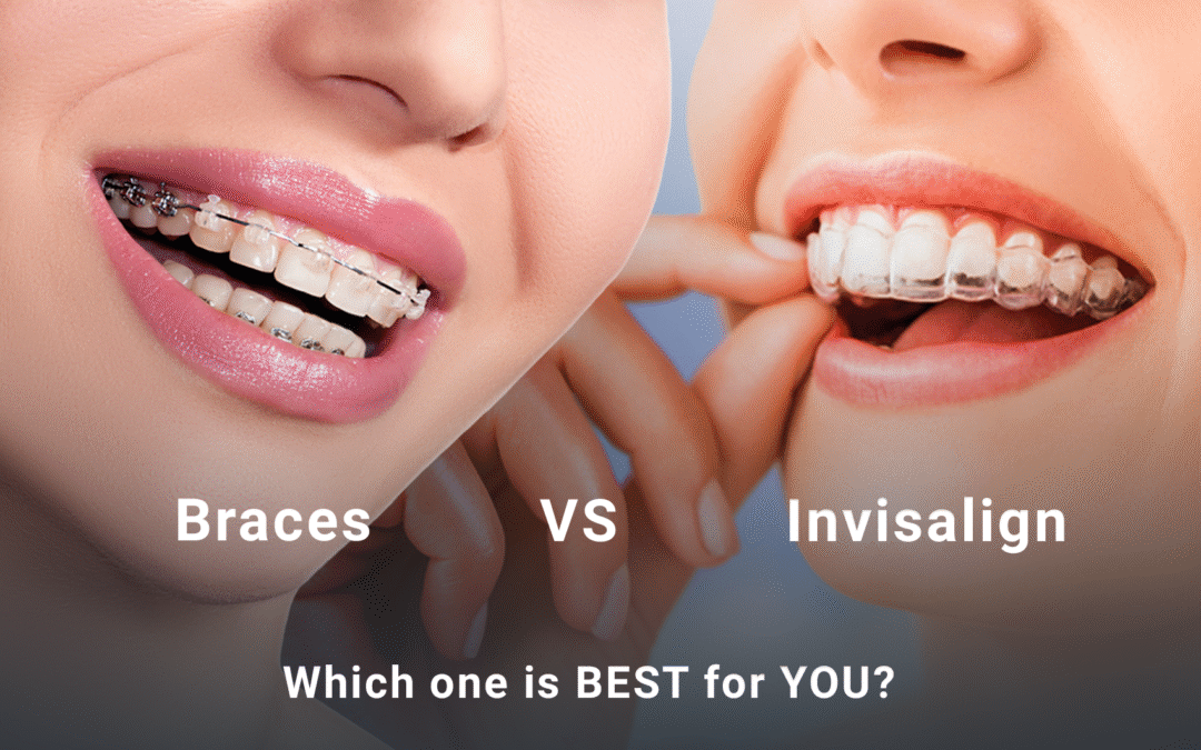 Invisalign vs Metal Braces: Which One is Best for You?