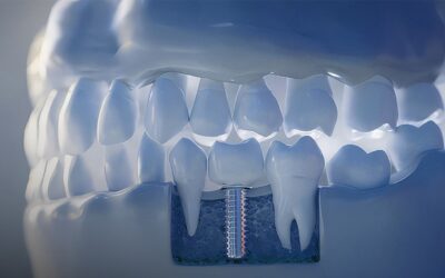 5 Common Dental Implant Complications and How to Avoid Them