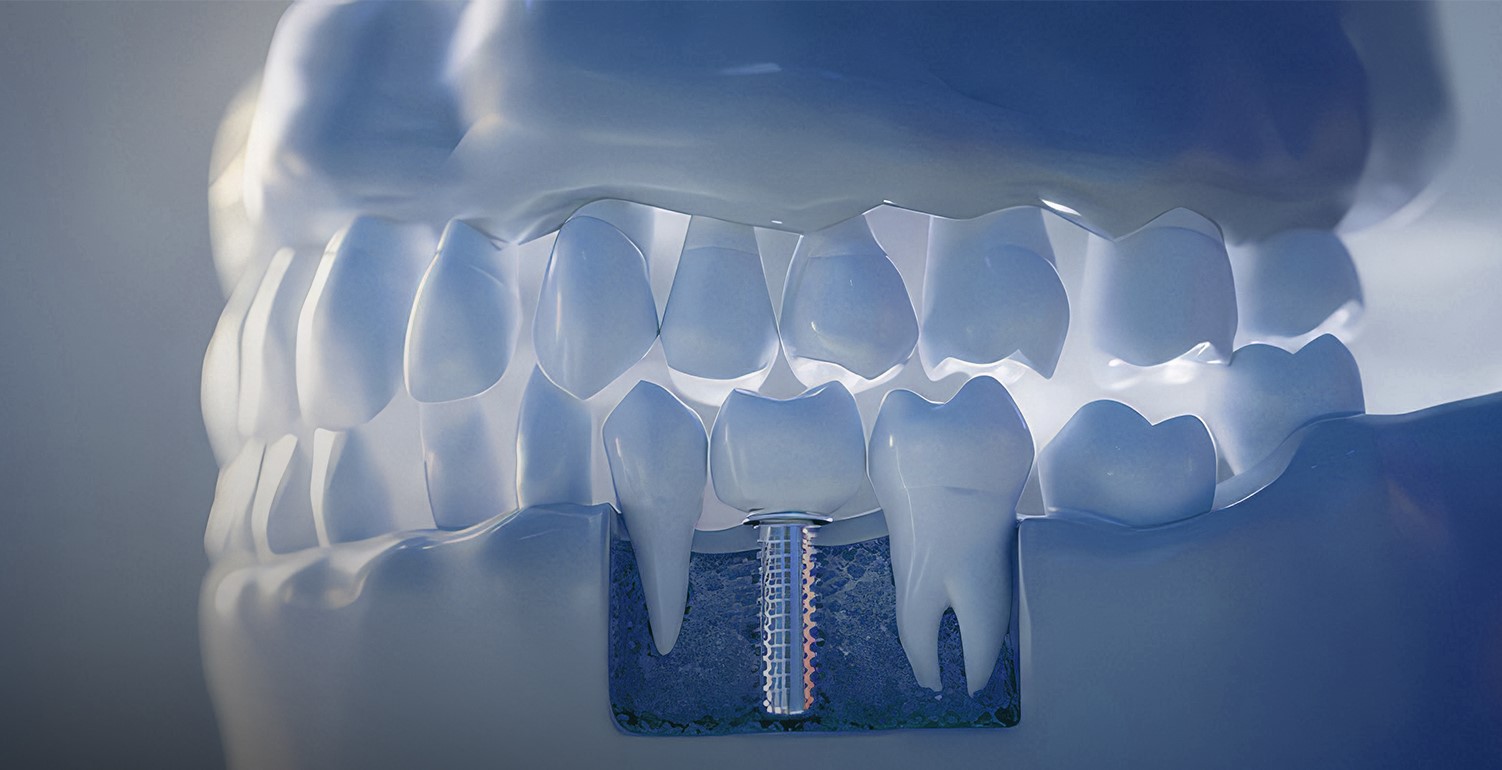 Dental Implant Complications A 3D model showing a dental implant in the jawbone