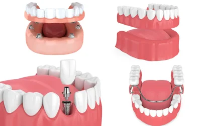Dental Implants vs. Dentures: Choose the Best for Your Smile