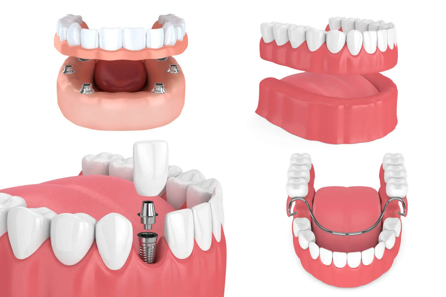 Dental Implants vs. Dentures Choose the Best for Your Smile A 3D model showcasing different types of dental implants, including fixed bridges, individual implants, and removable dentures with metal clasps