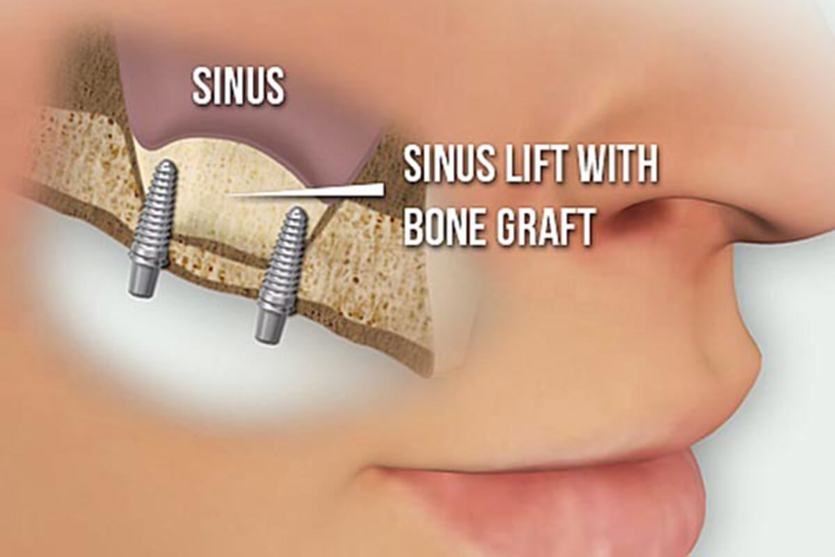 a sinus lift procedure with bone grafting for dental implants