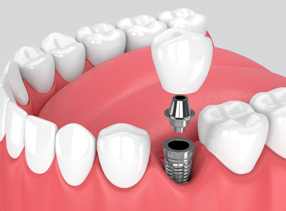 A 3D model illustrating the process of a dental implant, showing the titanium post integrated into the jawbone and the artificial tooth crown