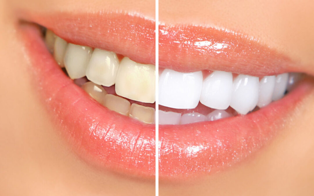 Is Coffee Harming Your Smile? Here’s The Truth!