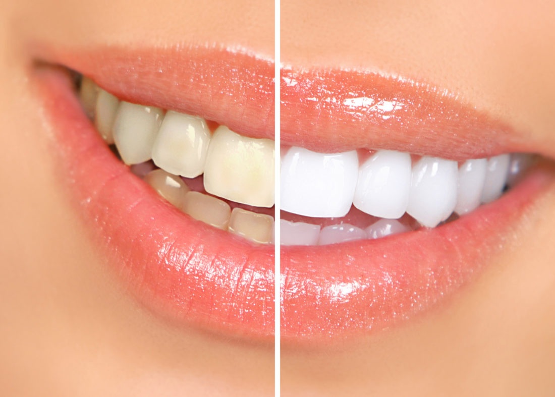 teeth whitening A before-and-after image showing the transformation of teeth from stained to bright white
