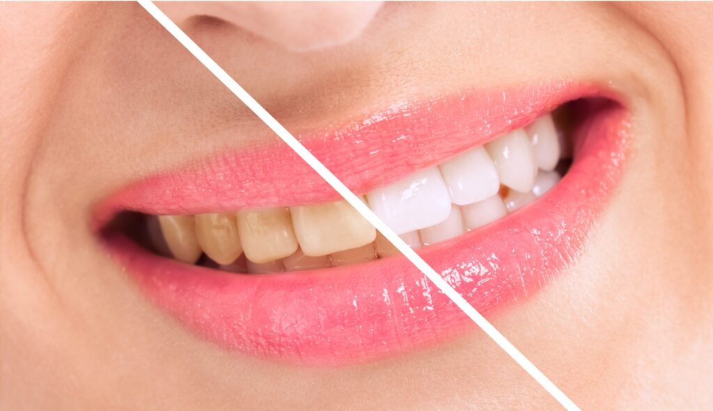 A before-and-after image showing the transformation of teeth from stained to bright white