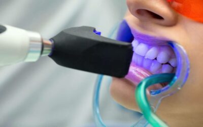 Nano Teeth Whitening in the UAE