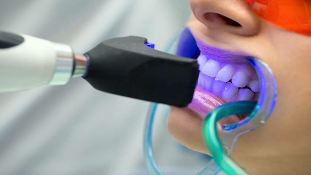 Laser teeth whitening A dental laser is being used to whiten teeth, with a purple light illuminating the area