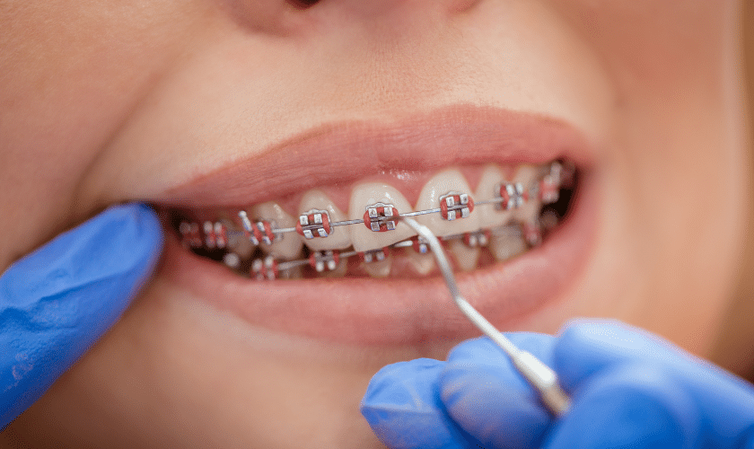 A dental professional is adjusting braces on a patient's teeth using specialized tools.
