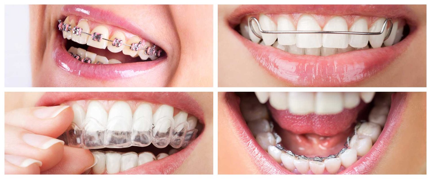 The-Orthodontist—Types-of-Braces صورة مجمعة تظهر أنواعًا مختلفة من علاجات تقويم الأسنان، بما في ذلك التقويمات التقليدية، والتقويمات اللسانية، والتقويمات الشفافة