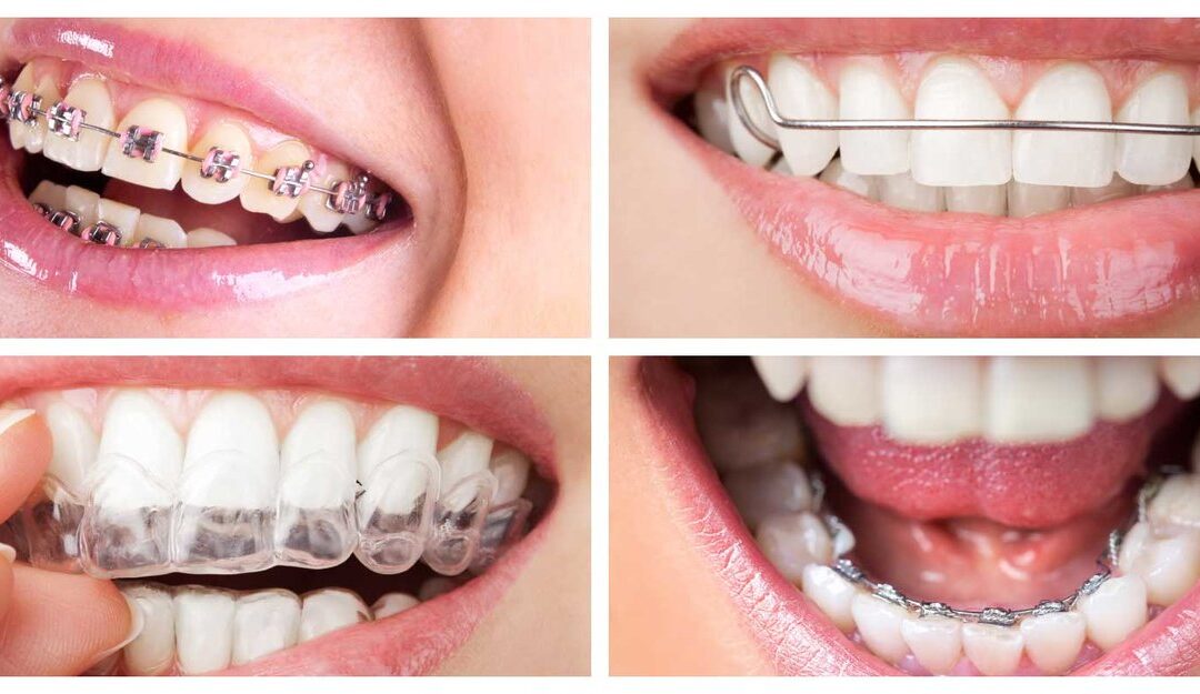 Orthodontics in Abu Dhabi: Which One is Your Go-To Type?
