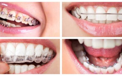 Orthodontics in Abu Dhabi: Which One is Your Go-To Type?