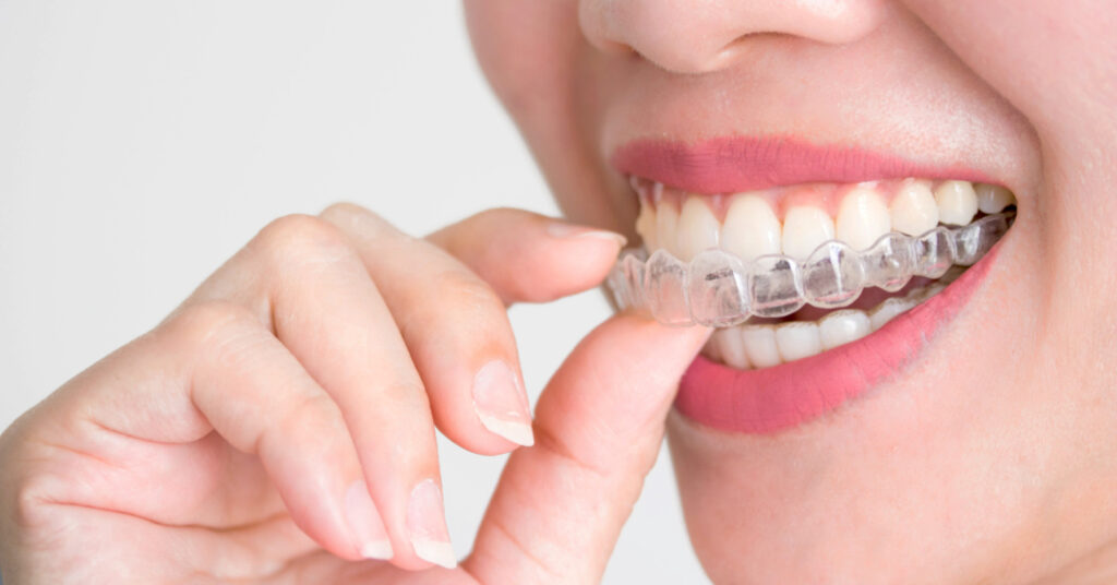 A person holding a clear aligner tray, demonstrating the process of placing it over their teeth