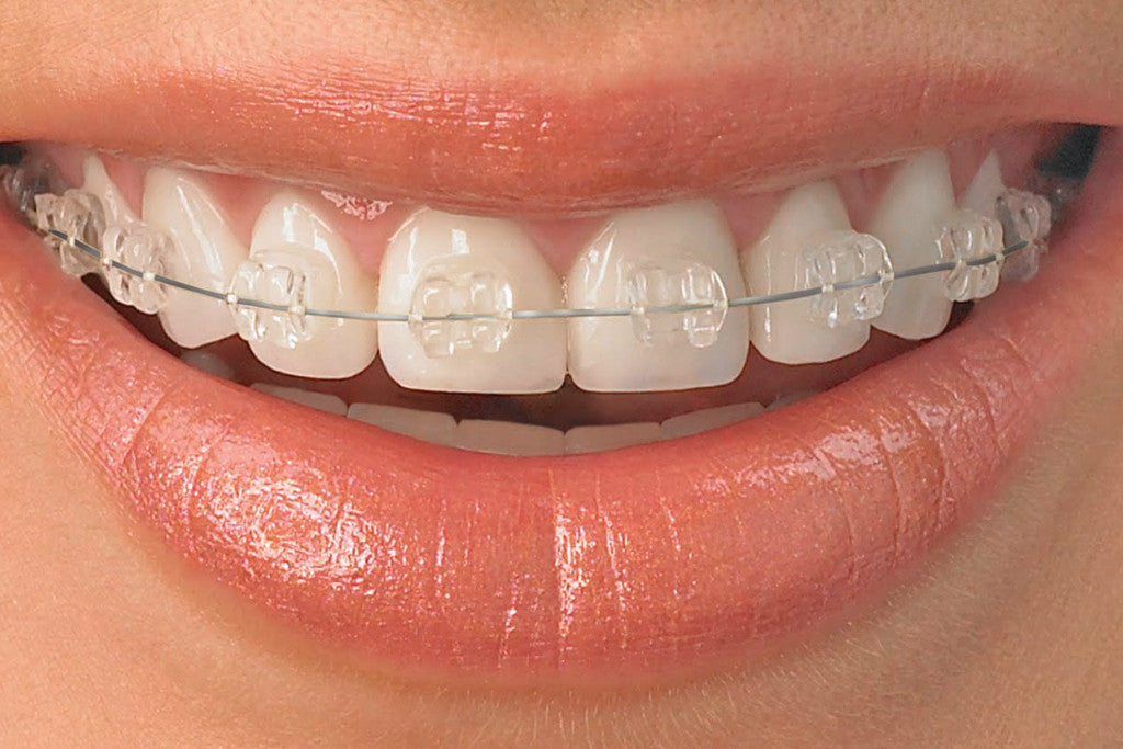 A close-up of a person's smile with ceramic braces on their teeth.