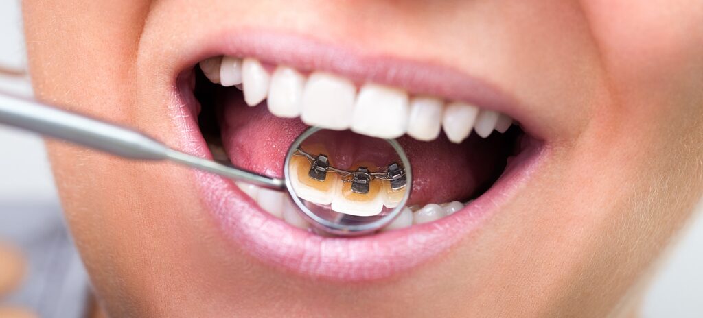 A dental mirror reflects the use of lingual braces on the backside of a person's teeth.