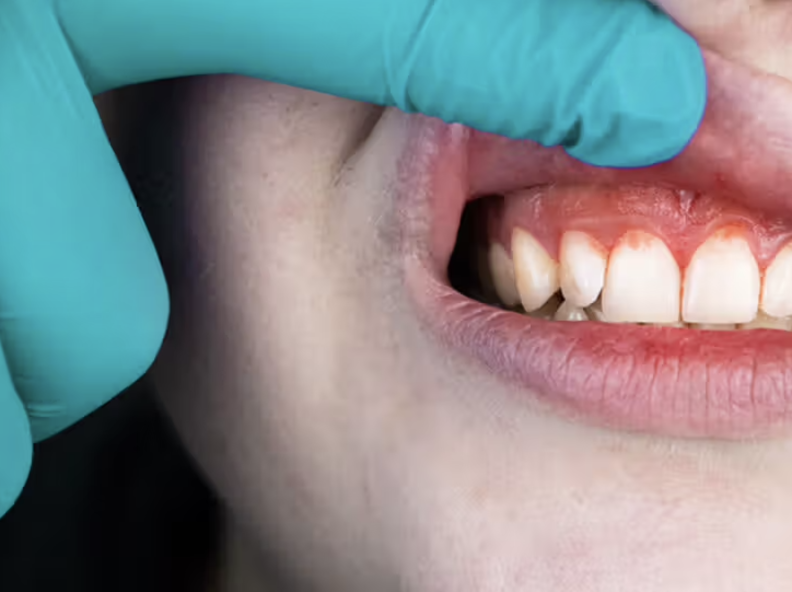 A close-up of a person’s mouth showing swollen and inflamed gums, indicating signs of Gum bleeding.

