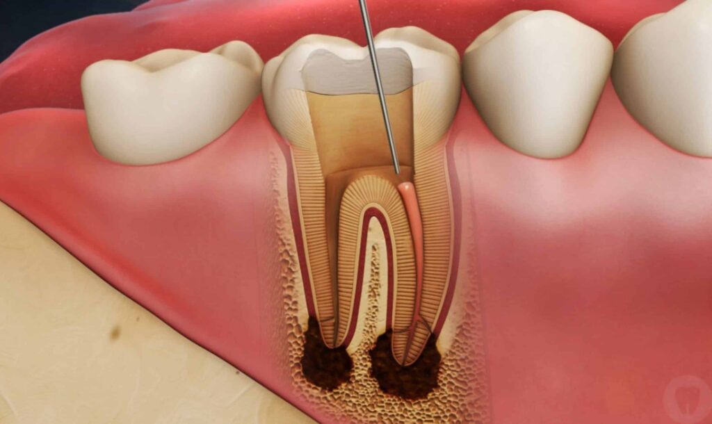 A 3D illustration showing the process of root canal treatment, highlighting the removal of infected pulp and cleaning of the root canals.