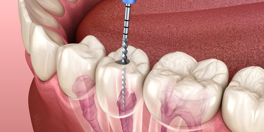 A 3D illustration showing the process of root canal treatment, with a dental instrument being inserted into the tooth to clean and disinfect the pulp chamber and root canals.

