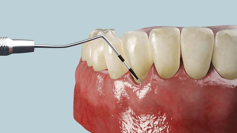 A 3D illustration showing a dental probe measuring the depth of the gum pocket around a tooth, indicating periodontal assessment.