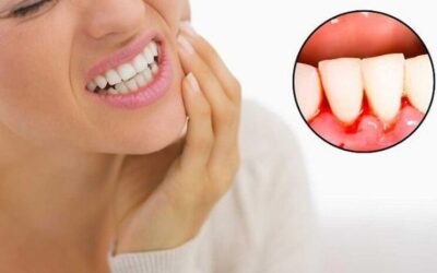 أسباب نزيف اللثة وطرق العلاج