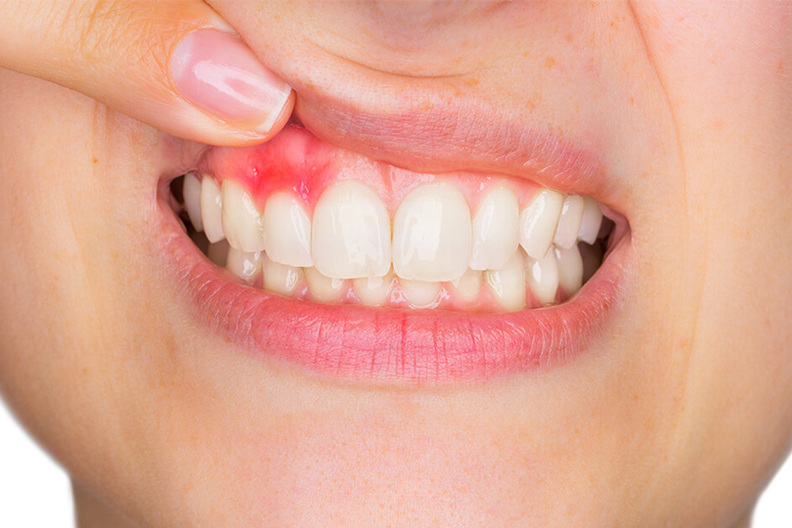 A close-up of a person’s mouth showing swollen and inflamed gums, indicating signs of gum disease.