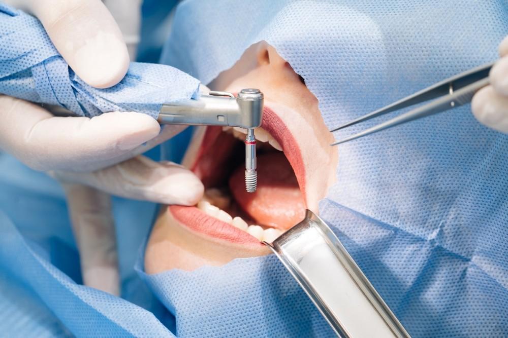 A dentist performing a root canal treatment on a patient's tooth using specialized dental instruments.