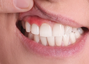 علاج اللثة