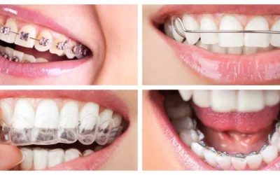 أنواع تقويم الأسنان في أبوظبي: أيها يناسبك؟