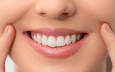 What to Do After Teeth Whitening? 