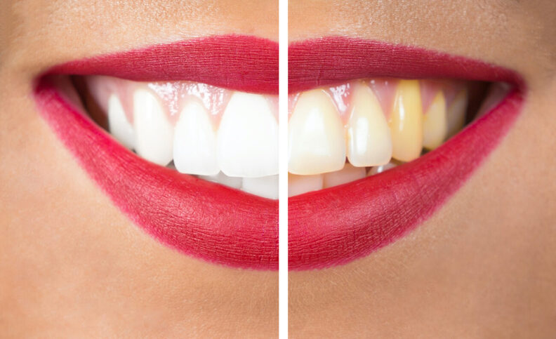 Close-up of a smile with red lipstick showing a comparison: Discover the difference teeth whitening can make to your smile.