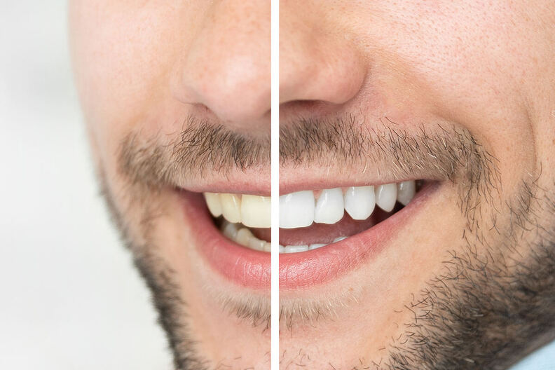 صورة مقربة لابتسامة رجل تُظهر مقارنة بين أسنان صفراء على اليسار وأسنان مبيضة على اليمين، شاهد الفرق الواضح مع تبييض الأسنان.