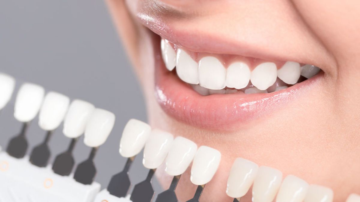 Close-up of a woman’s smile showing a shade guide being used to compare teeth color for whitening results.