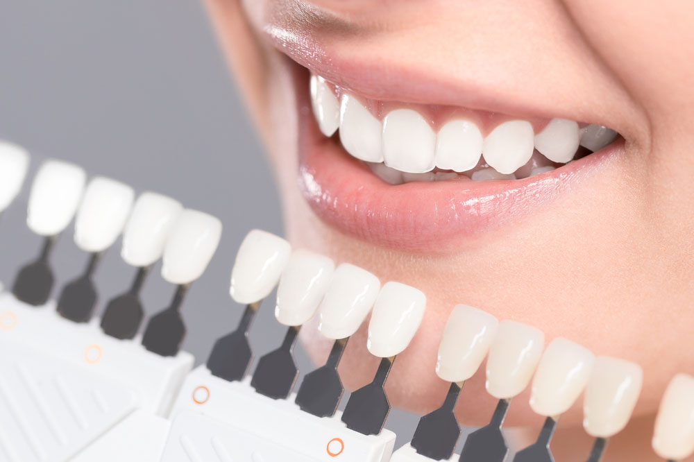 Teeth-whitening-scale_1000x Close-up of a smiling woman’s teeth being compared with a shade guide during a teeth whitening procedure.