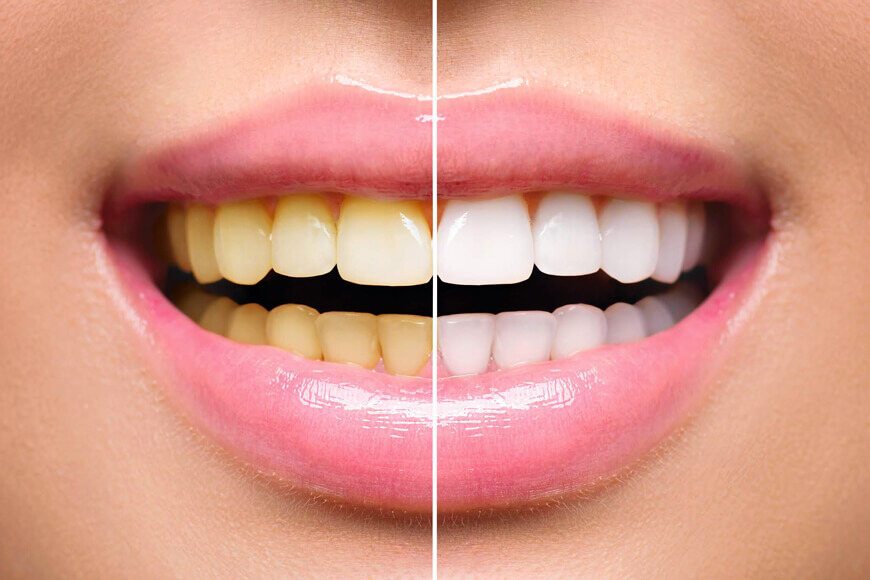 Close-up comparison showing teeth before and after whitening left side yellowish, right side visibly brighter and whiter.