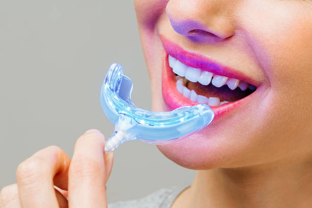 Woman using an at-home nano LED teeth whitening device, smiling while placing the blue light mouth tray on her teeth.