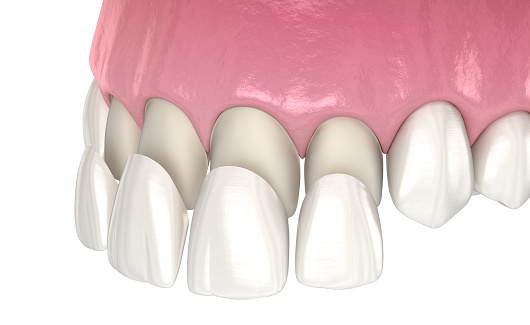 3D illustration showing dental veneers applied to front teeth for a Hollywood Smile treatment.