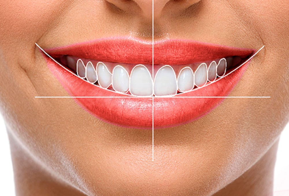 Close-up of a woman’s smile with digital lines and outlines illustrating the ideal proportions of a Hollywood Smile design.