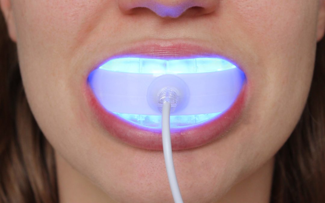 Close-up of a person using a home LED teeth whitening device with a blue light mouthpiece.