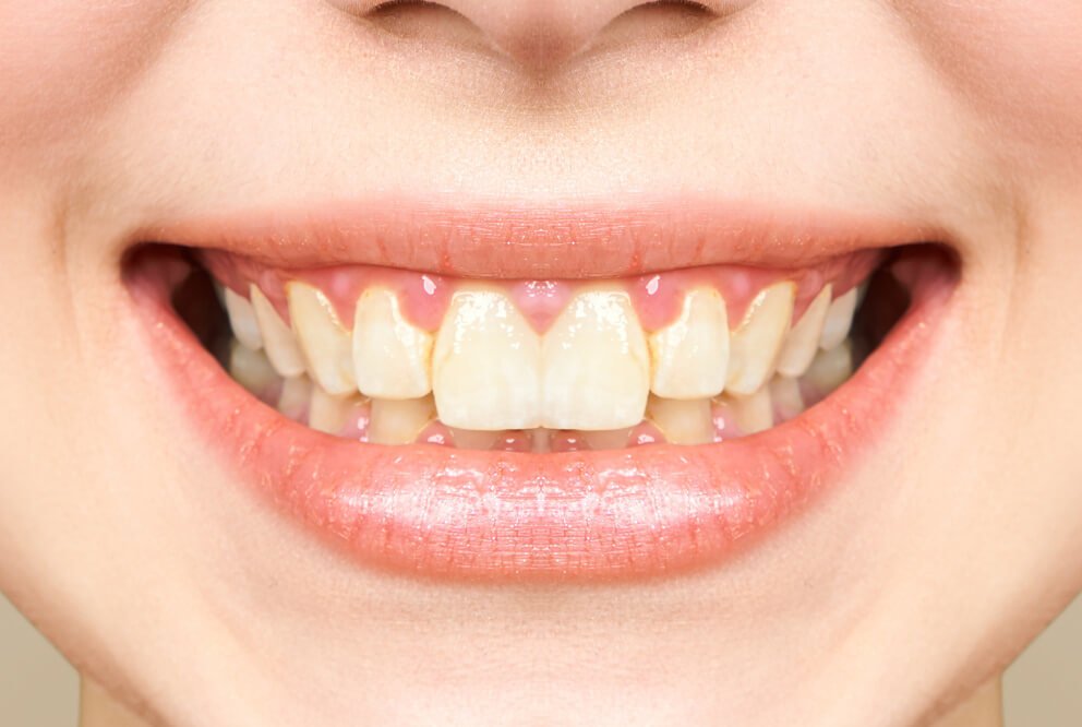 6790b4e2-ae0c-4b33-98ad-e60116692d3c-c4de1123-1d90-42de-b0d1-ba4ed3bebca0-woman-teeth-before-after-whitening-image-symboliz