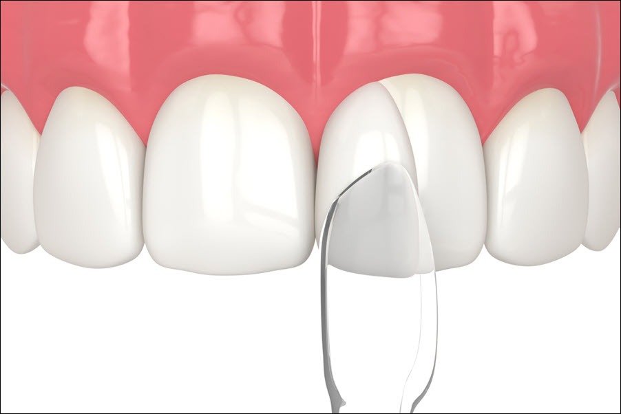 3D illustration showing the placement of a thin porcelain or composite veneer on the front surface of a tooth for cosmetic restoration.
