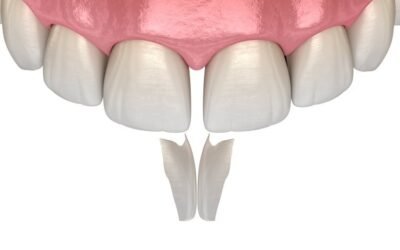 Composite Bonding: The Fastest Way to Fix your Teeth