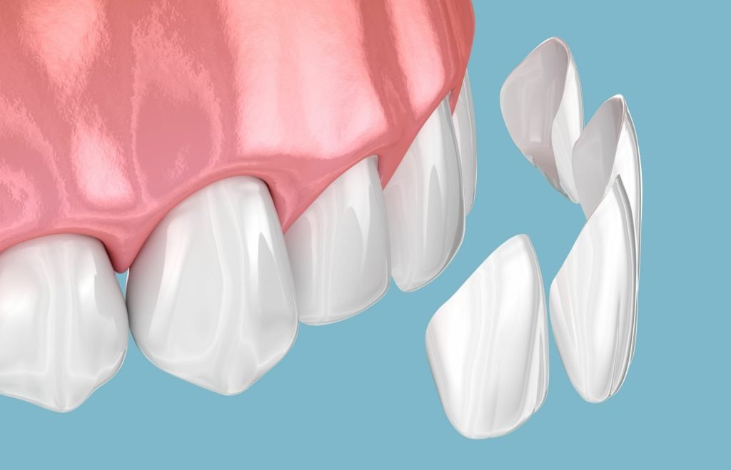3D illustration showing dental veneers or composite shells being placed on the front surface of teeth for aesthetic restoration.