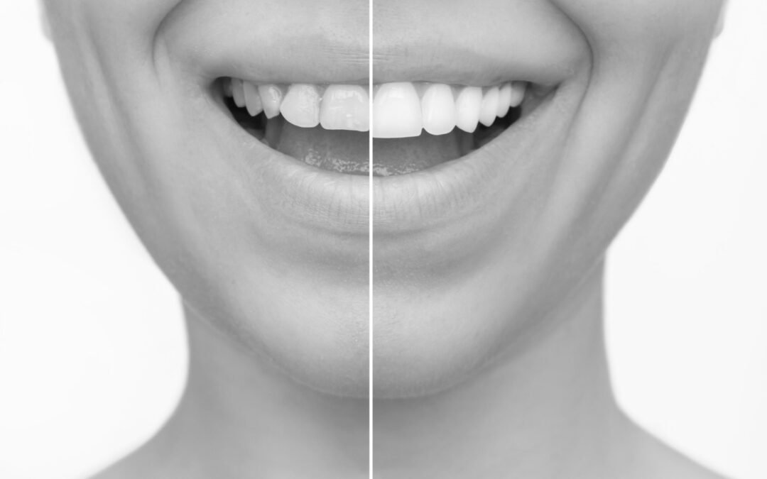 Teeth Bonding Explained: Affordable Smile Enhancement