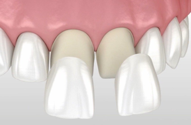 3D illustration showing the application of a composite resin layer to restore and reshape front teeth during a bonding procedure.