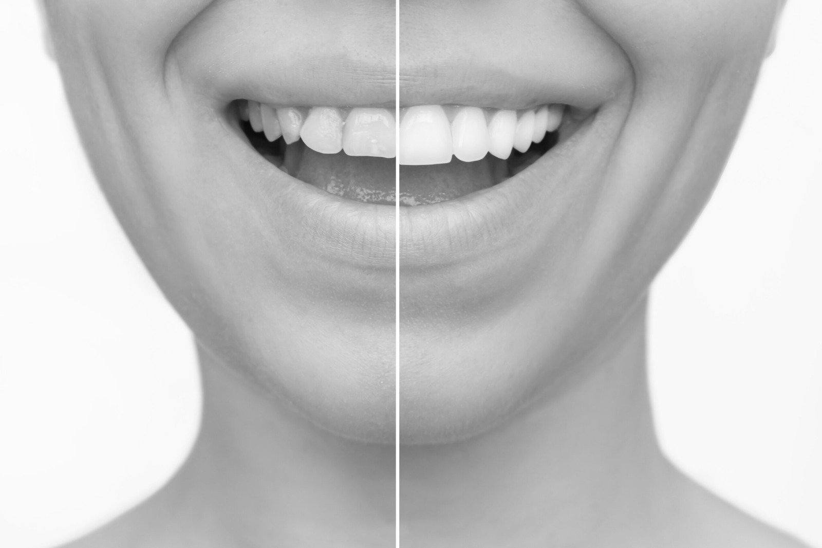 Teeth Bonding Black and white close-up image of a smile showing a before-and-after comparison of teeth — one side discolored and uneven, the other side bright and smooth after bonding.
