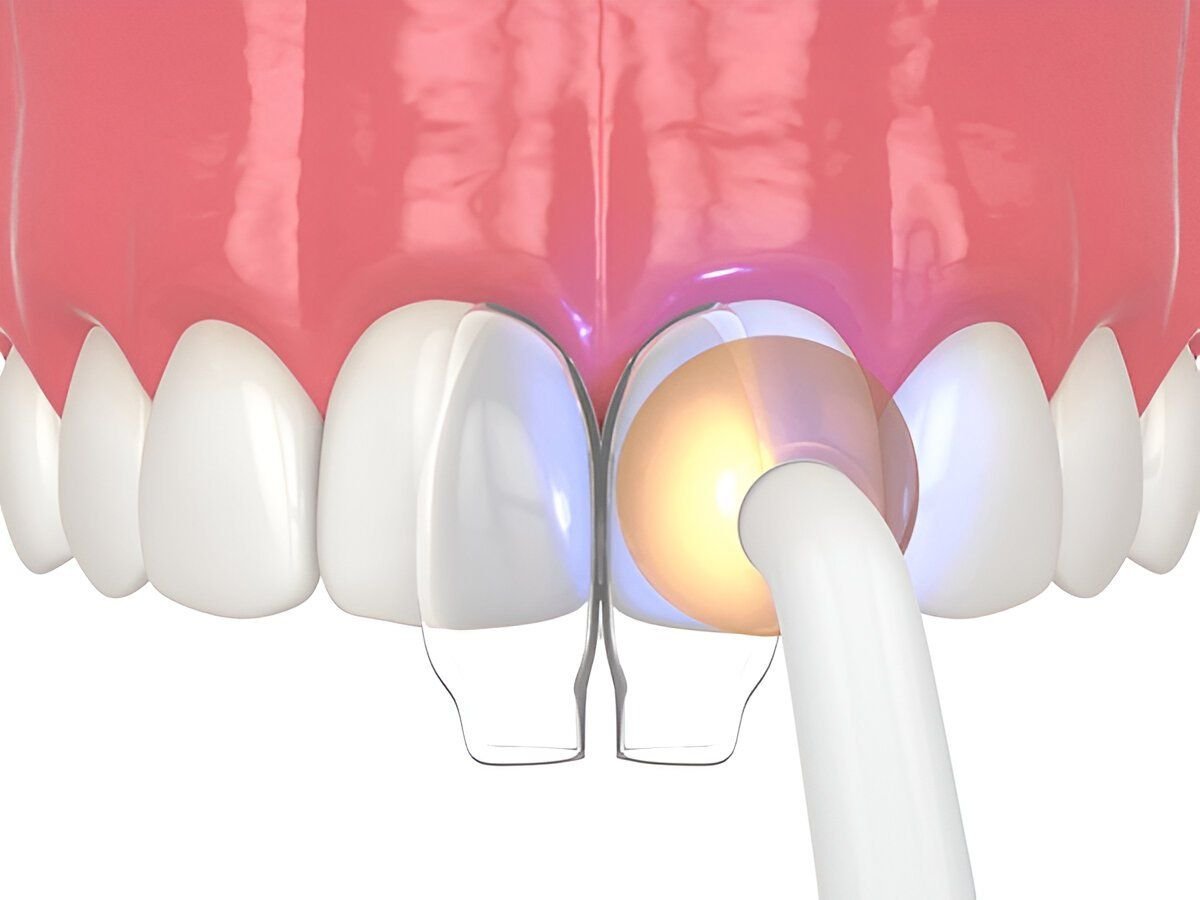 3D illustration showing a dentist curing a composite resin layer on a front tooth with a special blue light during a bonding procedure.