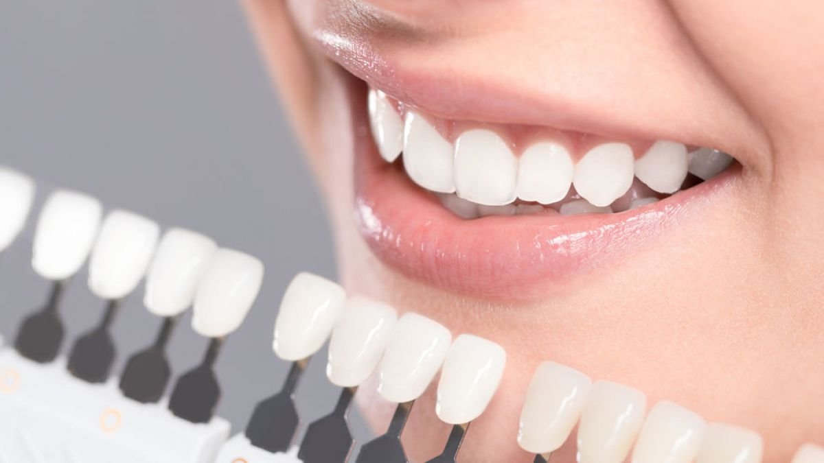 ابتسامة بيضاء مع مقارنة درجات تبييض الأسنان باستخدام دليل ألوان التبييض داخل العيادة.