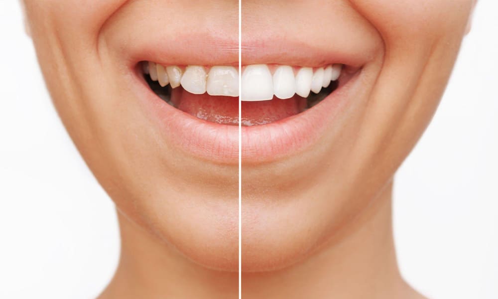 Before-and-after results of a Hollywood Smile transformation.