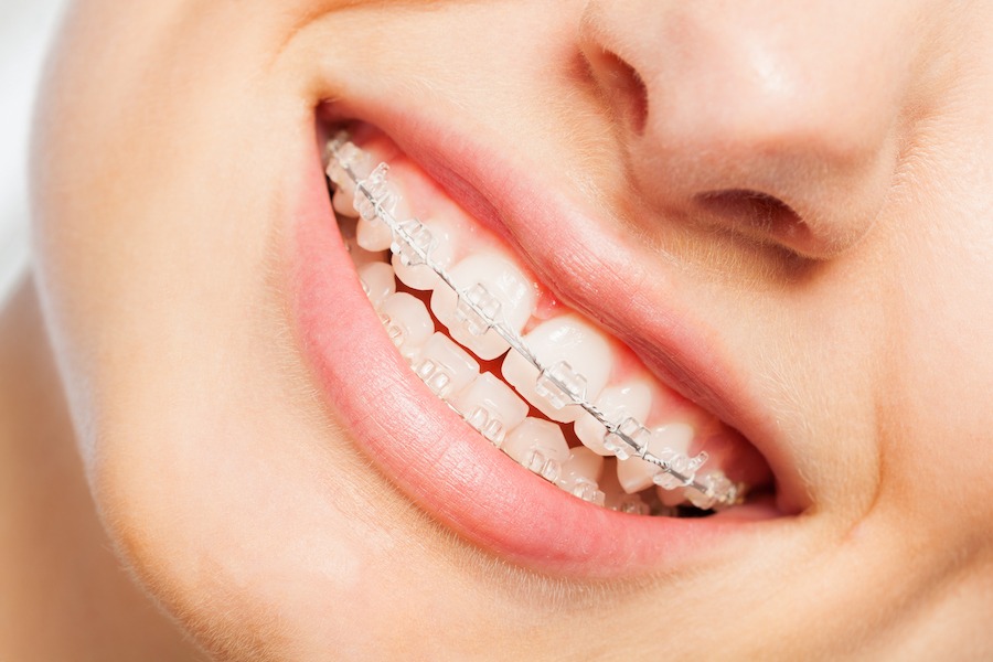 Clear ceramic braces on teeth showing discreet orthodontic treatment option in Abu Dhabi