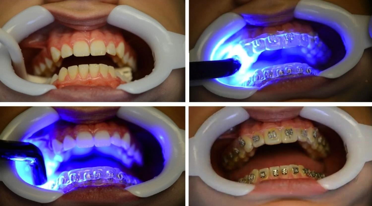 Stages of metal braces placement showing bonding and curing process during orthodontic treatment